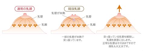 仮性陥没乳頭はどうやって治す？症状・治療方法を詳しく解説